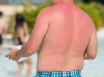 Queenslanders overweight and sunburnt